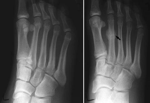 STRESS FRACTURES