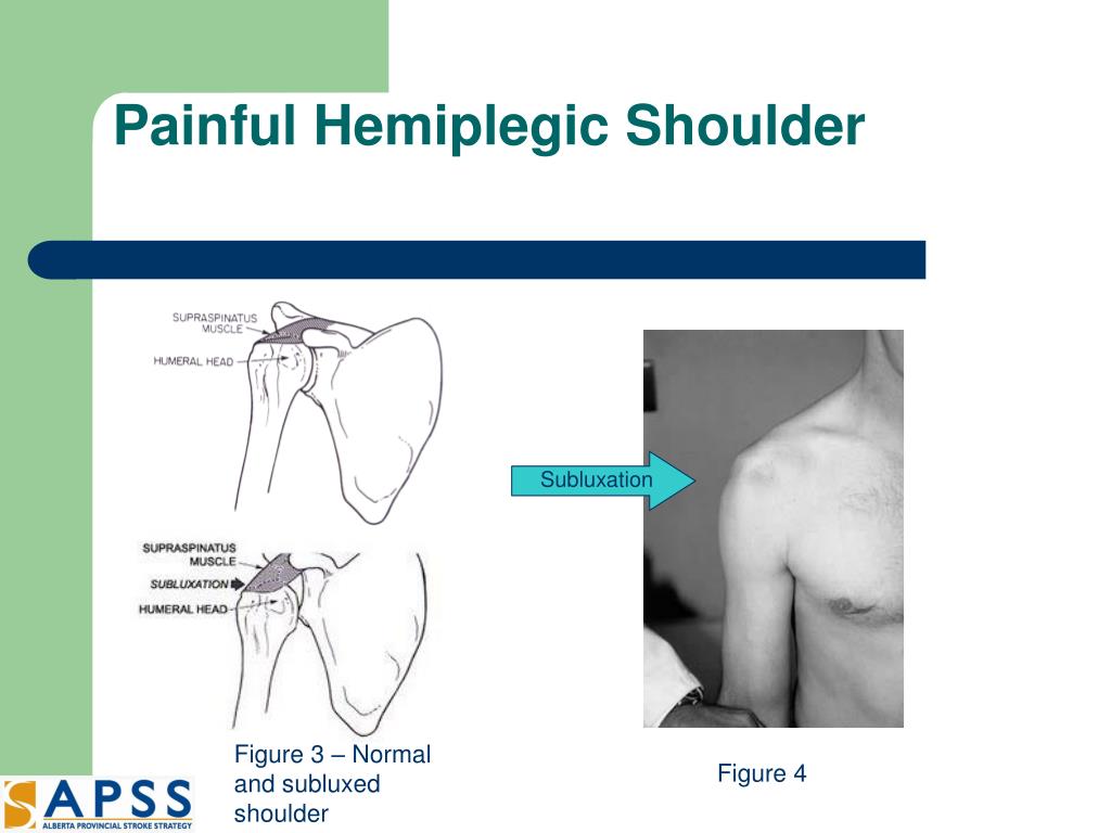 Shoulder Subluxation, what is it, and how do I fix it?