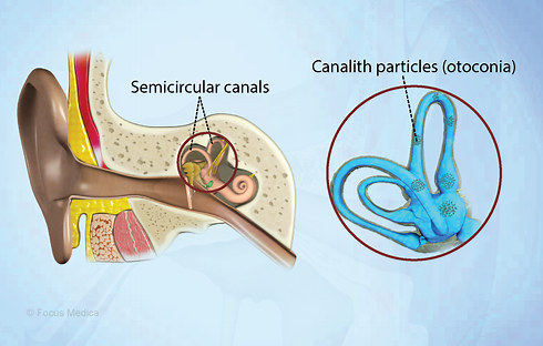 Vertigo BBPV Symptoms, Causes and Treatment.