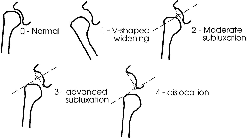 Shoulder Subluxation After Stroke: